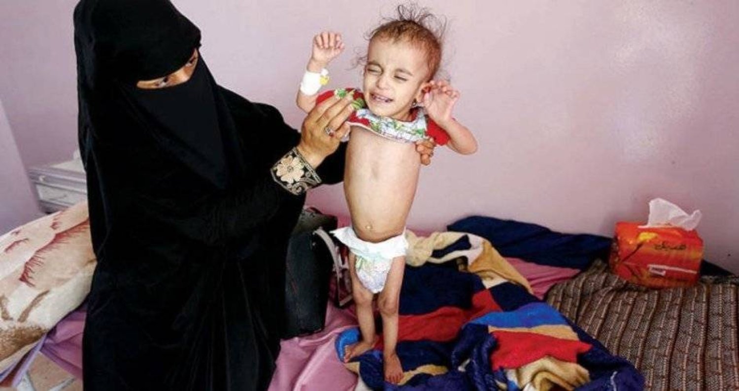 ألفا يمني ماتوا بالملاريا خلال شهرين وأكثر من 82 ألف إصابة في 8 محافظات تسيطر عليها المليشيات